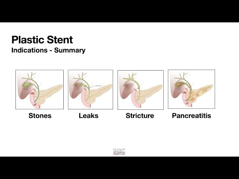 HCC 1474 -17a Plastic stents