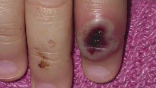 CDC wants Americans to be aware of the monkeypox virus and outbreak