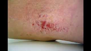 HOW TO CLEAR YOUR ECZEMA IN JUST 3 DAYS...YES 3 DAYS!