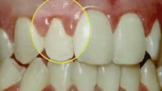 Periodontal Disease &amp; Treatment