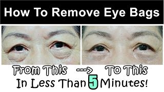 How To Get Rid of & Remove Eye Bags (Instantly Ageless Puffy Eye Bag Removal)
