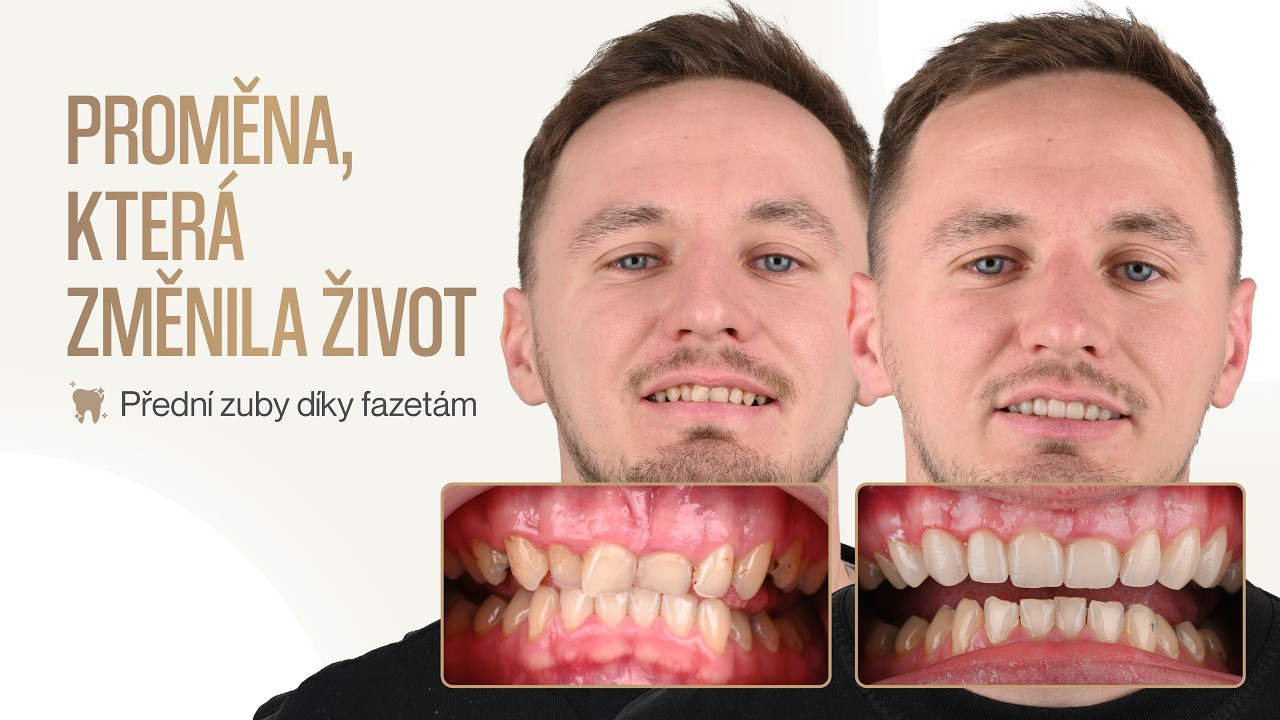 Estetická rekonstrukce předních zubů v EDClinic