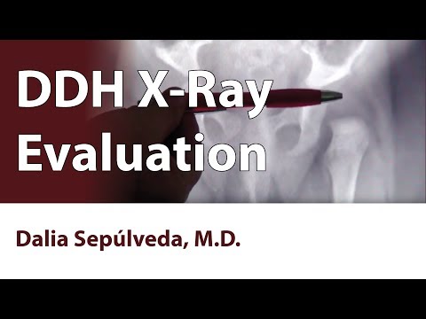 DDH X-Ray Evaluation