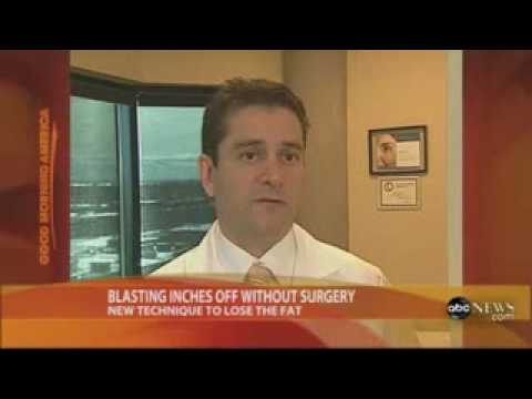 Good Morning America Featuring Ultrashape