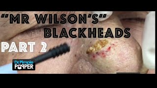 Recap  &quot;Mr Wilson&#39;s&quot; Blackheads &amp; Rhinophyma PART 2