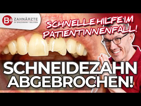Schneidezahn abgebrochen!😱 Was nun? Patientenfall mit Veneer gelöst + Vorher-Nachher im Vergleich!