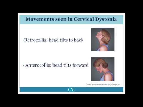 Part 4 - What is Cervical Dystonia?