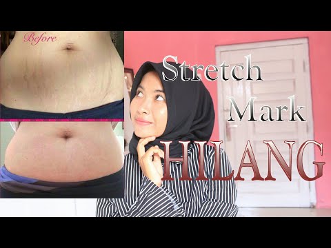 Menurunkan berat badan sehingga kulit tidak lemas Cara menurunkan berat badan pada kaki mereka untuk video seminggu