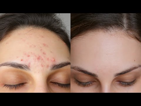 BENZOYL PEROXIDE FOR ACNE ❤️ Step-by-Step Guide on HOW TO USE IT Without SIDE EFFECTS