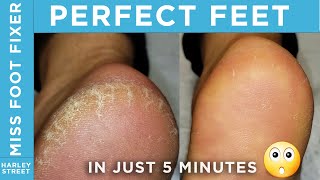 Perfect Heel, how to remove cracked and heels by podiatrist By Miss Foot Fixer Marion Yau