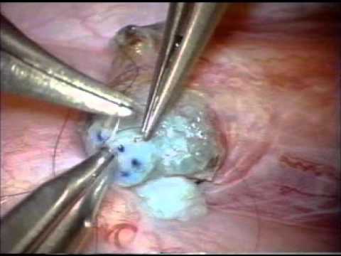 LIVE Technique | Center for Male Reproductive Medicine & Microsurgery