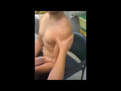 Shoulder Relocation - Cunningham Technique