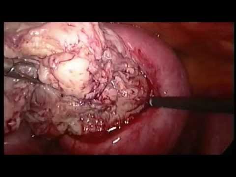 Cuscino ortopedico con osteocondrosi cervicale acquistare St. Petersburg Displasia dellanca nei bambini di scena
