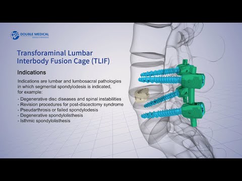 Double Medical Transforaminal Lumbar Interbody Fusion Cage (TLIF)
