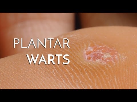 YouTube video about: Can athlete's foot cause plantar warts?