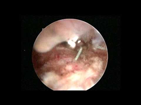 deteriorarea cornului meniscului tratamentului articulației genunchiului