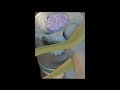 Lumbar Disc Prolapse And Sciatic Pain