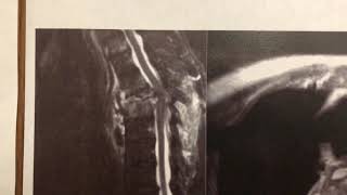 T4 Minimally Invasive Posterior Corpectomy