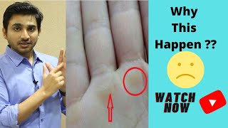 Hard skin on palm of hand |  How To Fix Calluses | The Overcompensation Principle |  BreatheFit TV