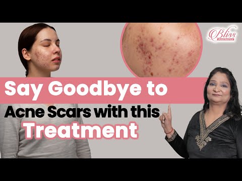 Targeted Peels for Acne Scars