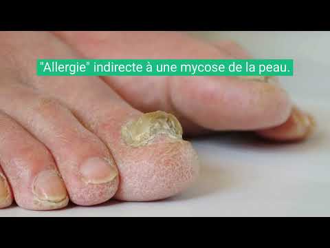 Vidéo : dysidrose, cloques des mains et des pieds — Dr Rousseau, dermatologue Bordeaux