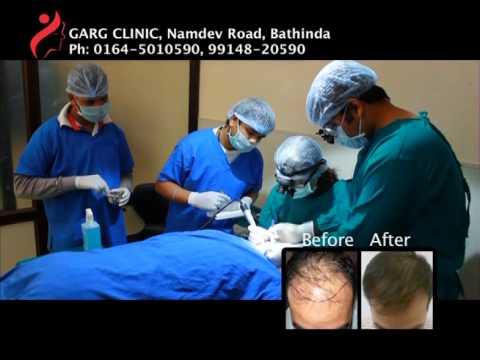 Garg Hair Transplant Thumbnail