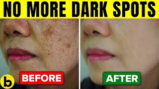 11 Home Remedies To Help Get Rid Of Your Dark Spots