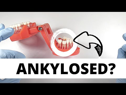 Jak usunąć ankylotyczne zęby?