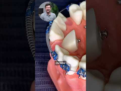 Mini Implantat um Zahn einzureihen 🦷🪢🦷