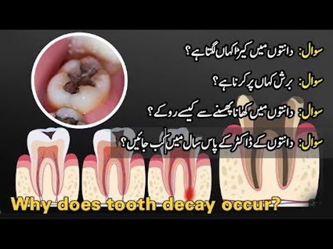 ⁣[Short Clip] Food stuck in the teeth and How to prevent
