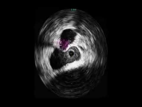 Iliac Vein Compression