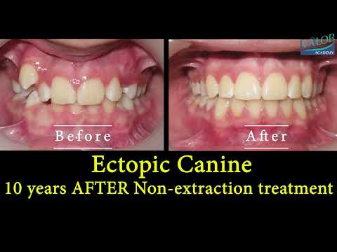 ✔ Trailer of Non-Extraction treatment of an Ectopic Canine and Midline shifting in 4K❗
