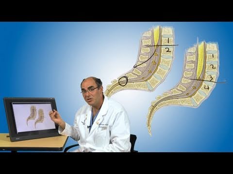 Tethered cord and its treatment | Boston Children’s Hospital