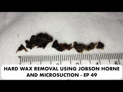 HARD EAR WAX REMOVAL USING JOBSON HORNE AND MICROSUCTION - EP 49