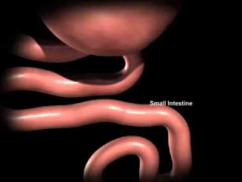 How does the Gastric Bypass Work?