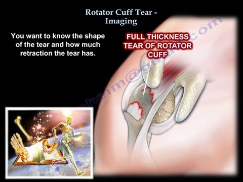 Rotator Cuff tear  Imaging - Everything You Need To Know - Dr. Nabil Ebraheim