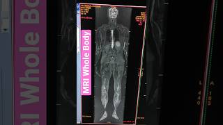 Whole Body MRI | GE 1.5 Tesla #viral #mri #youtubeshorts#radiology