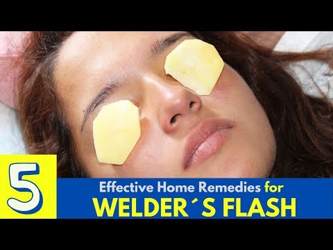 Top 5 Home Remedies To Treat Welder's Flash - Eye Pain Home Remedies - Arc Eye Home Remedies