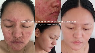 How I cleared acne rosacea without medication | Skincare storytime & simple routine