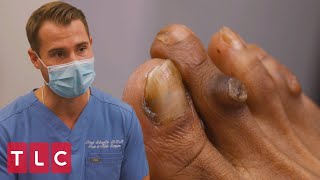 Robyn’s Corns | My Feet Are Killing Me