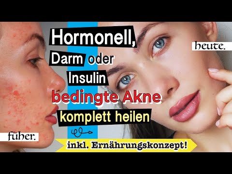 Buch über Diabetes HCG-Analyse bei Diabetes