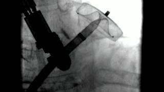 Video 16.12 Interventional Cardiac Electrophysiology
