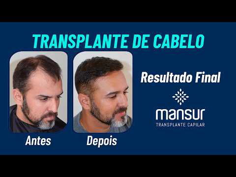 Miniatura do depoimento: Relato de Paciente - Transplante Capilar FUE