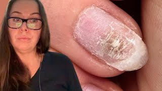 “Why is my nail green under the gel?”