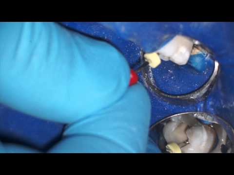 Root Canal Sealing - Louisville Endodontic Specialist