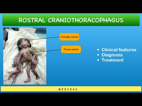 Conjoined Twins : Cranio-thoracophagus - Clinical features | Diagnosis | Treatment