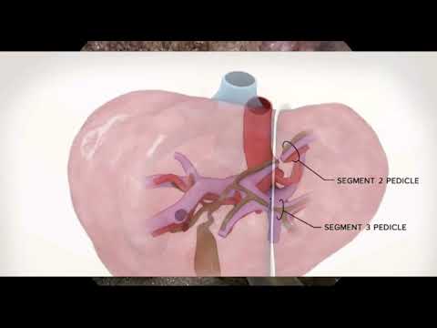 Chirurgia oncologica del fegato