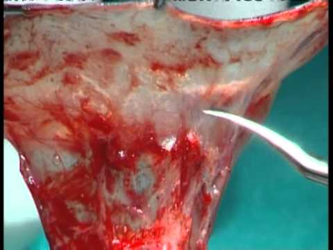 Fistula Prevention In Hypospadias Repair