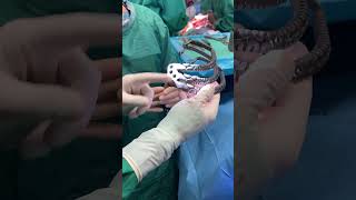Newswise:Video Embedded 3d-metallic-rib-implants-from-spain-give-teenage-cancer-patient-a-second-chance