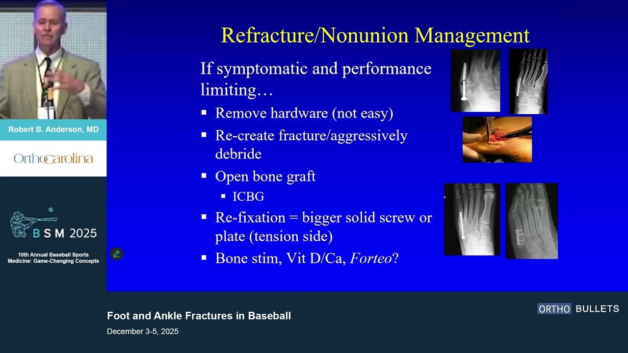 Foot and Ankle Fractures in Baseball_Robert B. Anderson MD
